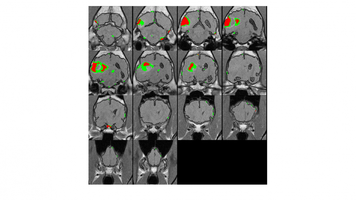 glioma