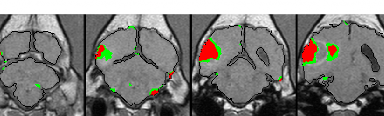 glioma
